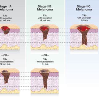 measuring melanoma thickness|melanoma stages chart.